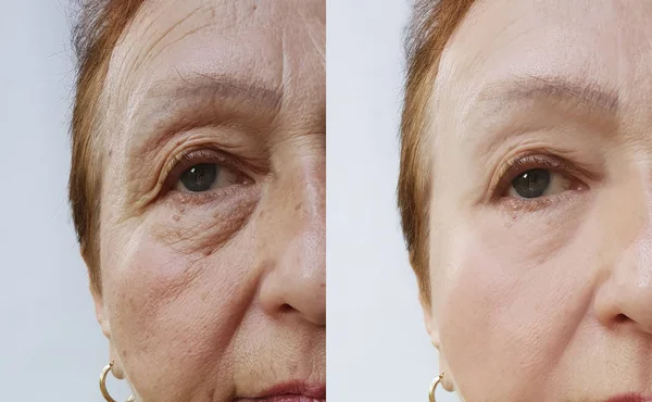 elderly woman wrinkles face before and after cosmetic procedures