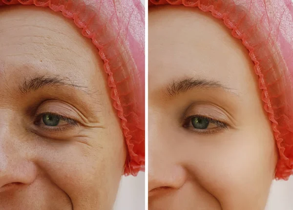 Wanita Wajah Keriput Sebelum Dan Setelah Prosedur Penuaan Kosmetik — Stok Foto