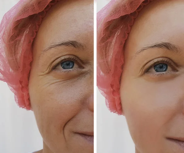 面部妇女皱纹前和后美容抗衰老程序 — 图库照片