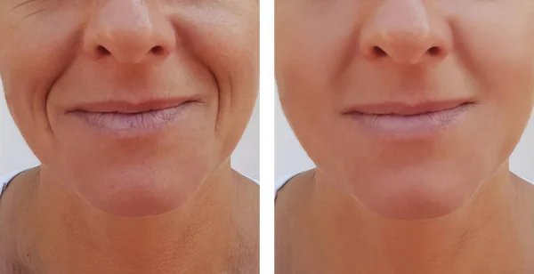 妇女在抗衰老程序前后脸上的皱纹 — 图库照片
