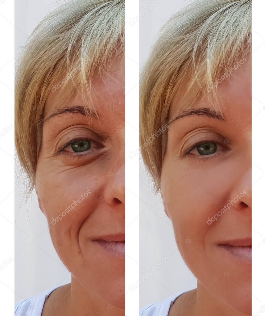 woman wrinkles on face before and after procedures anti-aging