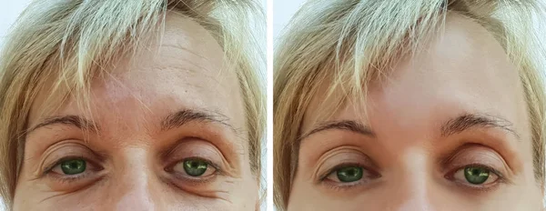 Wanita Keriput Wajah Sebelum Dan Setelah Prosedur Penuaan — Stok Foto