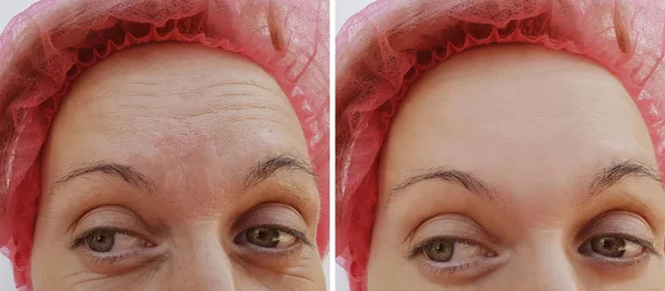 Forehead Wanita Keriput Sebelum Dan Setelah Prosedur Kosmetik Penghapusan — Stok Foto