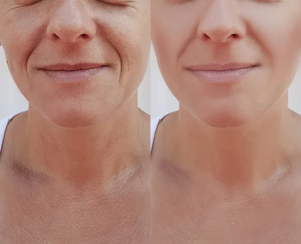 Cara Mujer Arrugas Antes Después Los Procedimientos Cosméticos — Foto de Stock