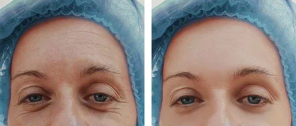 Enrugamentos Mulher Cara Antes Depois Procedimentos Cosméticos — Fotografia de Stock