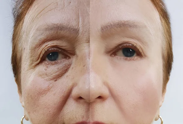 Cara Una Mujer Anciana Arrugas Antes Después Los Procedimientos — Foto de Stock