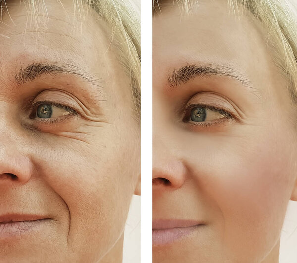 woman wrinkles face before and after cosmetic procedures