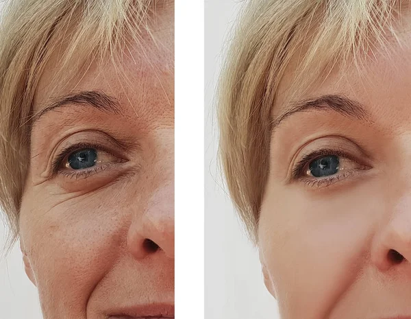 woman wrinkles face before and after cosmetic procedures