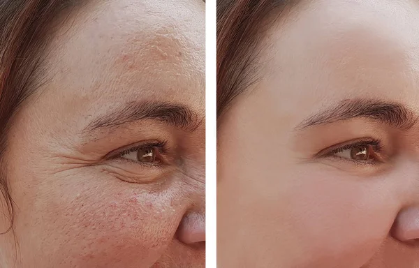Wanita Mata Keriput Sebelum Dan Setelah Prosedur Kosmetik — Stok Foto