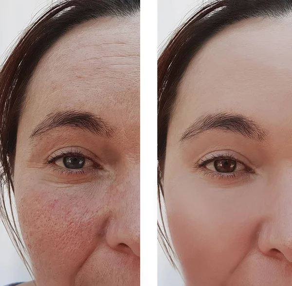 Wrinkles Eye Woman Face Cosmetic Procedures — Stock Photo, Image