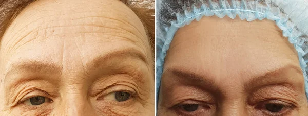 wrinkles elderly woman face before and after cosmetic procedures, therapy, anti-aging