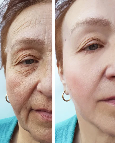 wrinkles elderly woman face before and after cosmetic procedures, therapy, anti-aging