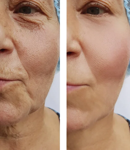 Yüzü Daha Önce Sonra Yaşlı Kadın Kırışıklıkları — Stok fotoğraf
