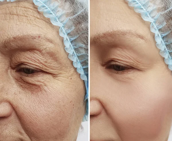 老年妇女在手术后脸上皱纹 — 图库照片