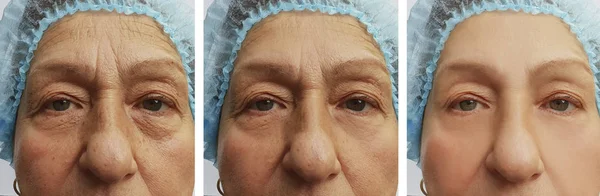 Ηλικιωμένη Γυναίκα Ρυτίδες Στο Πρόσωπο Πριν Μετά Από Διαδικασίες — Φωτογραφία Αρχείου