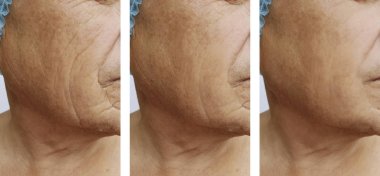 yüzü daha önce yordamlar sonra yaşlı erkekler kırışıklıkları