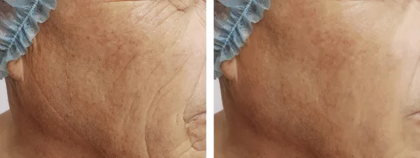 Elderly Men Wrinkles Face Procedures — Stock Photo, Image
