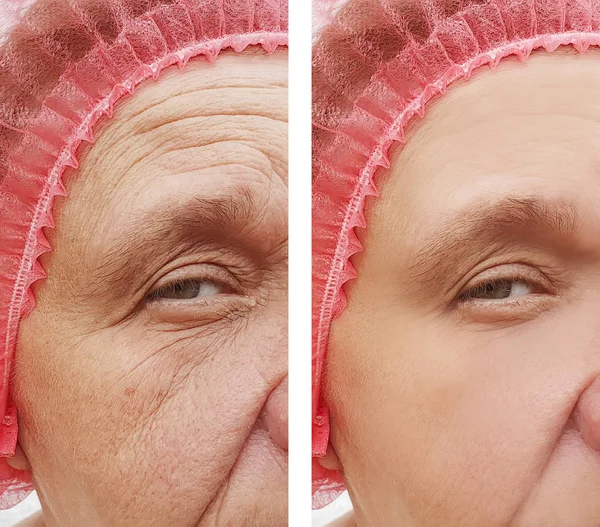 Arrugas Mujer Anciana Cara Antes Después Los Procedimientos Terapia — Foto de Stock