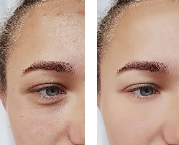 eye wrinkles young woman before and after cosmetology procedures