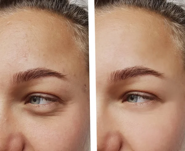 Rides Des Yeux Jeune Femme Avant Après Les Procédures Cosmétiques — Photo