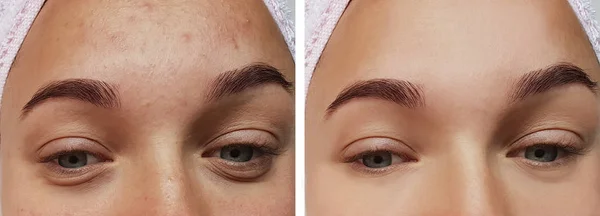 Girl Eye Treatment Procedures Acne — Stock Photo, Image