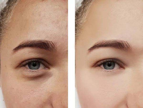 Tratamento Dos Olhos Menina Antes Depois Dos Procedimentos Acne — Fotografia de Stock