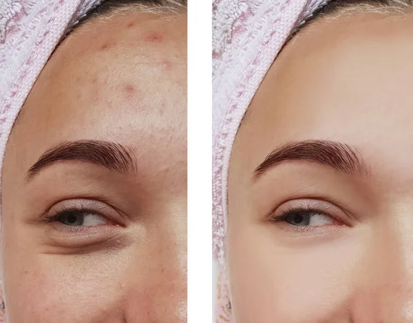 Tratamento Bonito Olho Menina Antes Depois Procedimentos Acne — Fotografia de Stock