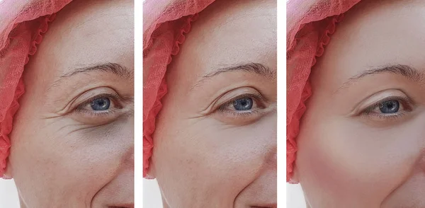 Mata Wanita Wajah Keriput Sebelum Dan Setelah Prosedur — Stok Foto