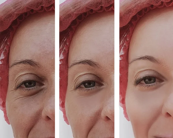 Eyes Woman Face Wrinkles Procedures — Stock Photo, Image