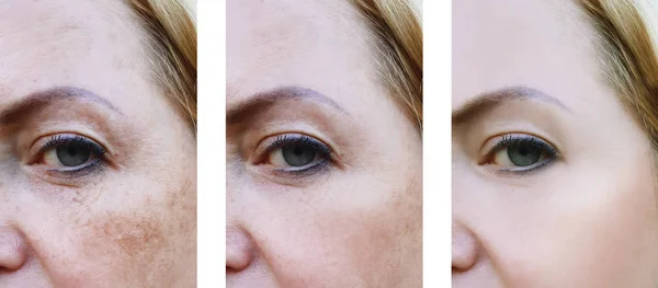 Yeux Femme Visage Rides Avant Après Les Procédures Pigmentation — Photo