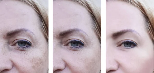 Ojos Mujer Cara Arrugas Antes Después Los Procedimientos Pigmentación — Foto de Stock