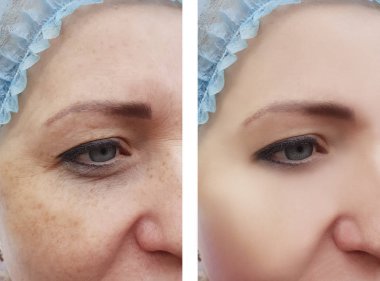 kadın yüz kırışıklıkları pigmentasyon öncesi ve sonrası yordamları