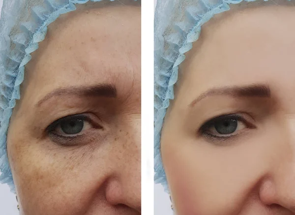 Mujer Cara Arrugas Pigmentación Antes Después Los Procedimientos — Foto de Stock