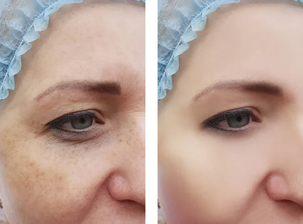 Woman Face Wrinkles Pigmentation Procedures — Stock Photo, Image