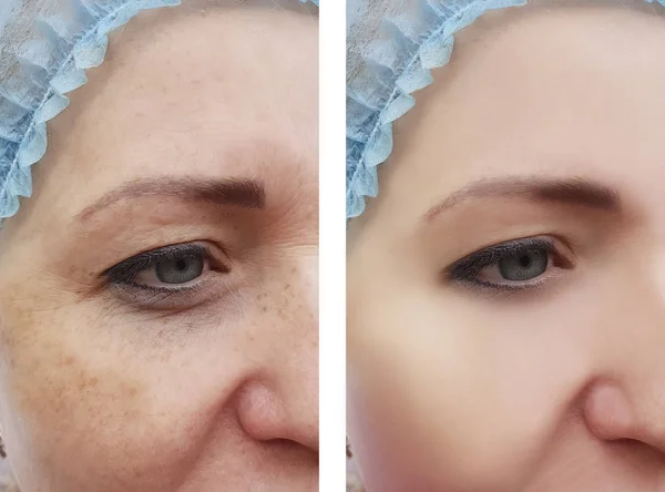 Femme Visage Rides Pigmentation Avant Après Les Procédures — Photo