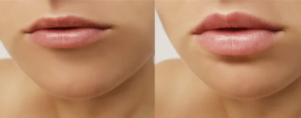 Labios Niña Aumentan Antes Después Los Procedimientos —  Fotos de Stock