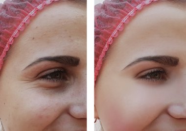 güzel kız kırışıklıklar yüzünde öncesi ve sonrası yordamları