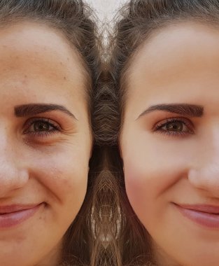 güzel kız kırışıklıklar yüzünde öncesi ve sonrası yordamları