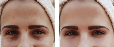 güzel kız kırışıklıklar yüzünde öncesi ve sonrası yordamları