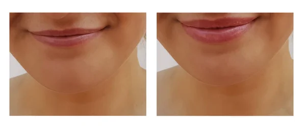 女孩嘴唇增量在过程之前和之后 — 图库照片