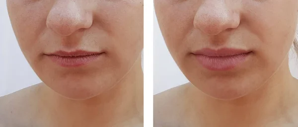 beautiful girl lips increase before and after procedures