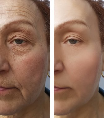 Yaşlı bir kadın yüzü kırışıklıklar daha önce ve sonra yordamları