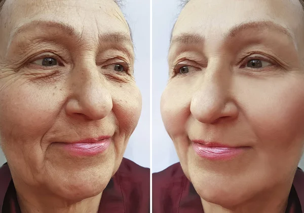 Egy Idős Asszony Arcát Előtt Után Kozmetikai Eljárások Arca — Stock Fotó