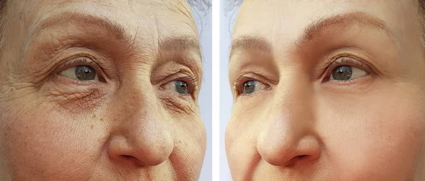 Πρόσωπό Της Μια Ηλικιωμένη Γυναίκα Στο Πρόσωπό Της Πριν Και — Φωτογραφία Αρχείου
