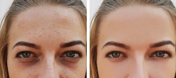 Saco Menina Olho Sob Olhos Antes Depois — Fotografia de Stock