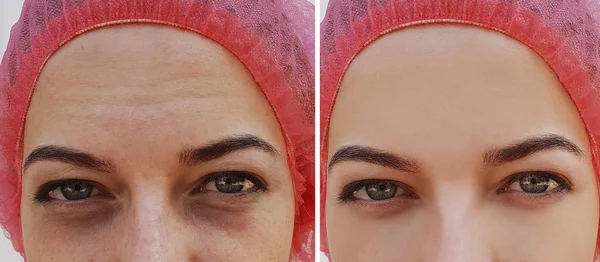 Inchaço Dos Olhos Rugas Antes Depois Procedimento Cosmético — Fotografia de Stock