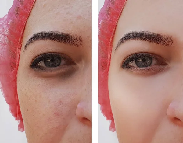 Silmien Turvotus Ryppyjä Ennen Jälkeen Kosmeettisen Menettelyn Akne Pigmentti — kuvapankkivalokuva