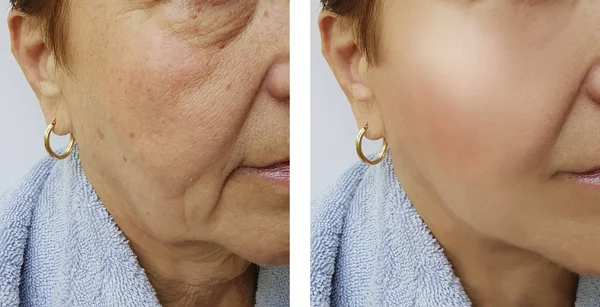 Elderly Woman Face Wrinkles Procedures — Stock Photo, Image