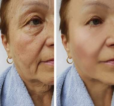 Yaşlı kadın yüz kırışıklıklar öncesi ve sonrası yordamları