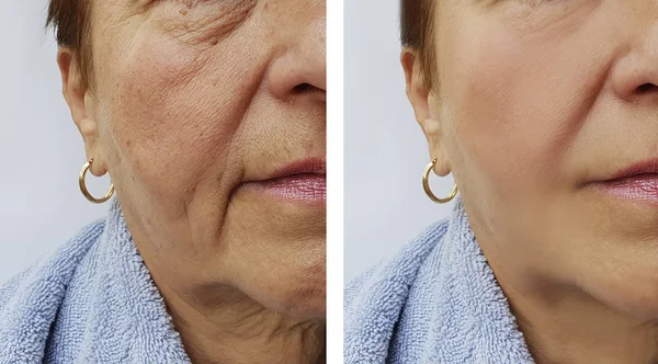 Rosto Uma Mulher Idosa Rugas Antes Depois Procedimentos — Fotografia de Stock